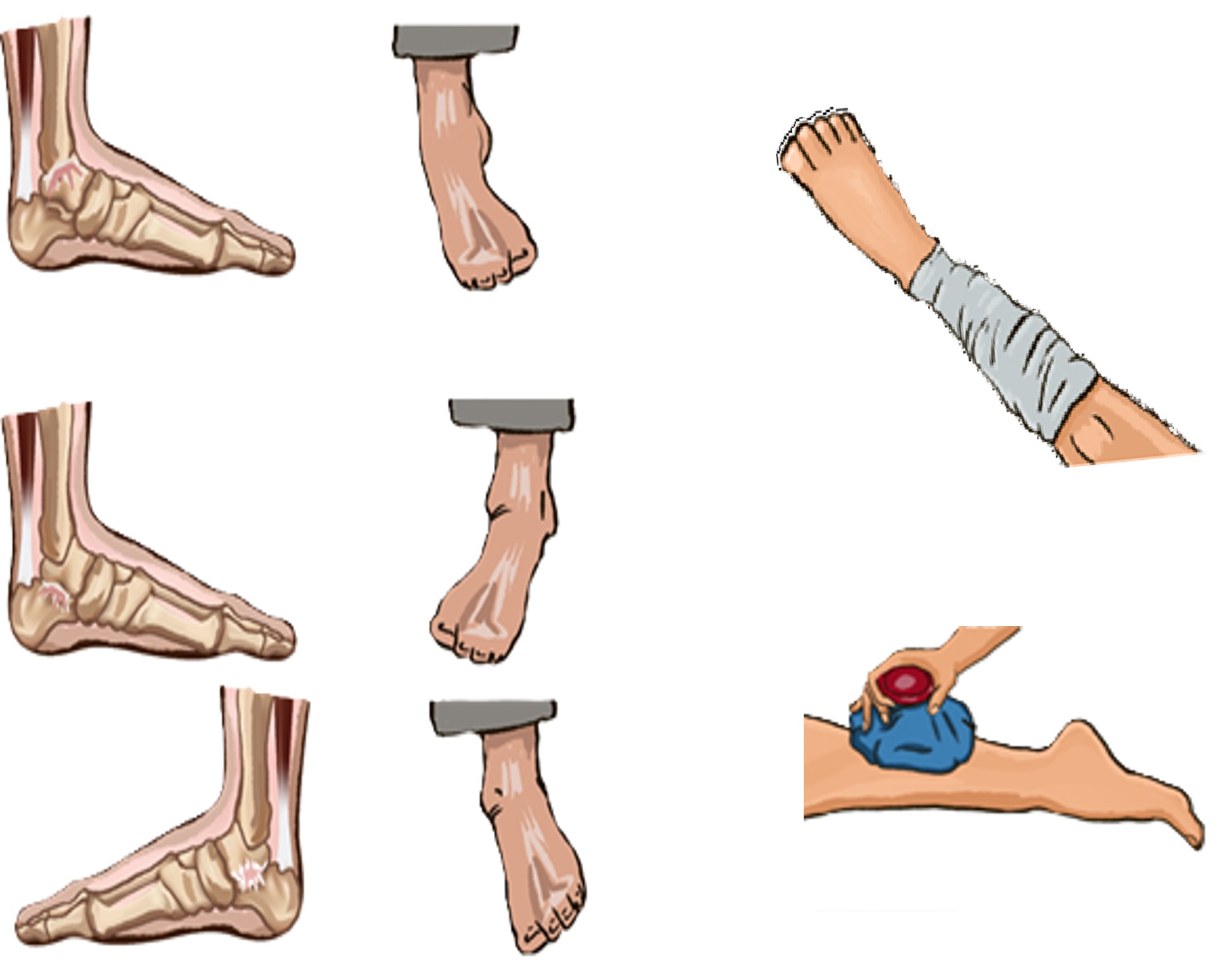 διαστρεμμα